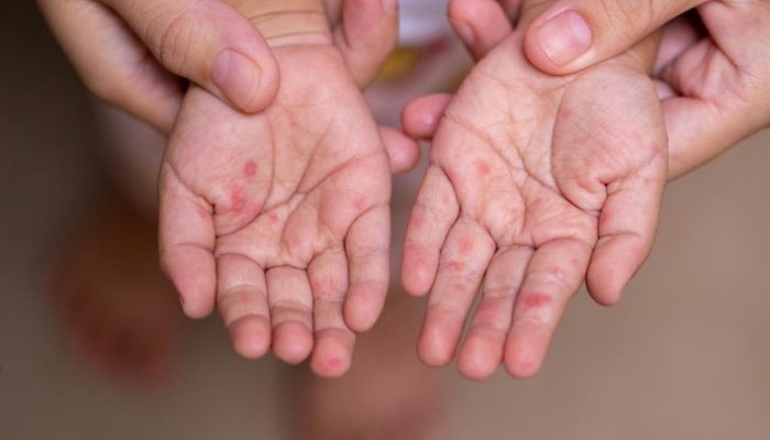 Dari Ruam hingga Komplikasi Berat, Ini Fakta Penting Campak pada Anak